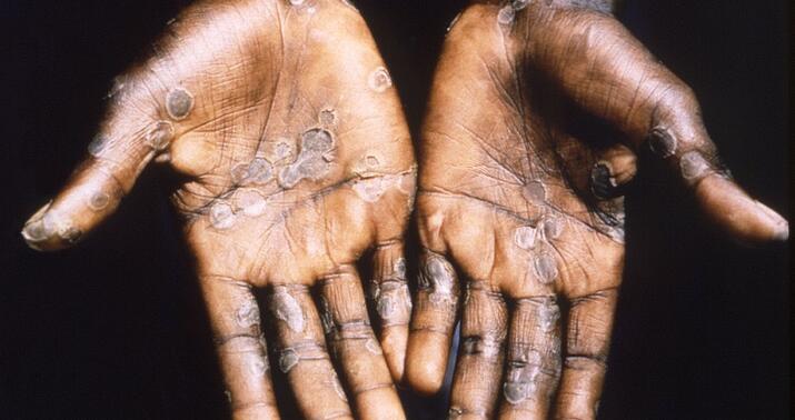 TƏBİB-dən "Meymun çiçəyi"nə -