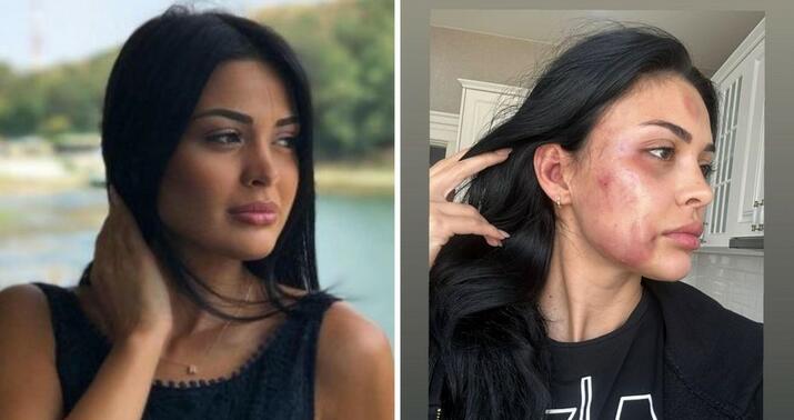 Bakıda modeli döyən sevgilisi həbs edildi
