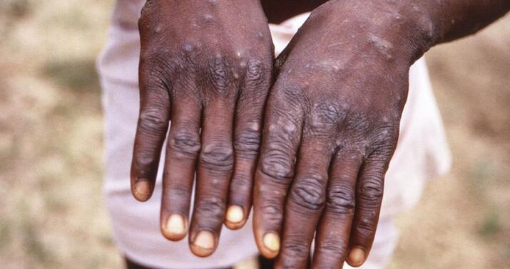 Konqoda 15 mindən çox insan meymunçiçəyinə yoluxdu