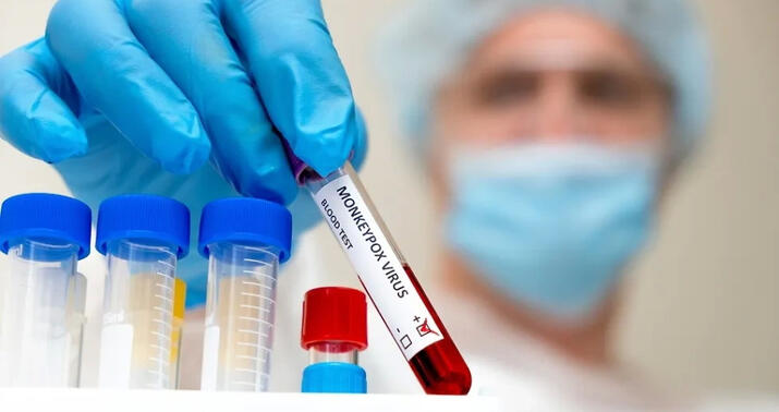 Daha bir ölkədə meymunçiçəyi virusu aşkar olundu