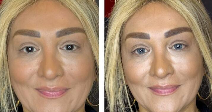 Aparıcı Mətanət əməliyyatla göz rəngini dəyişdi -